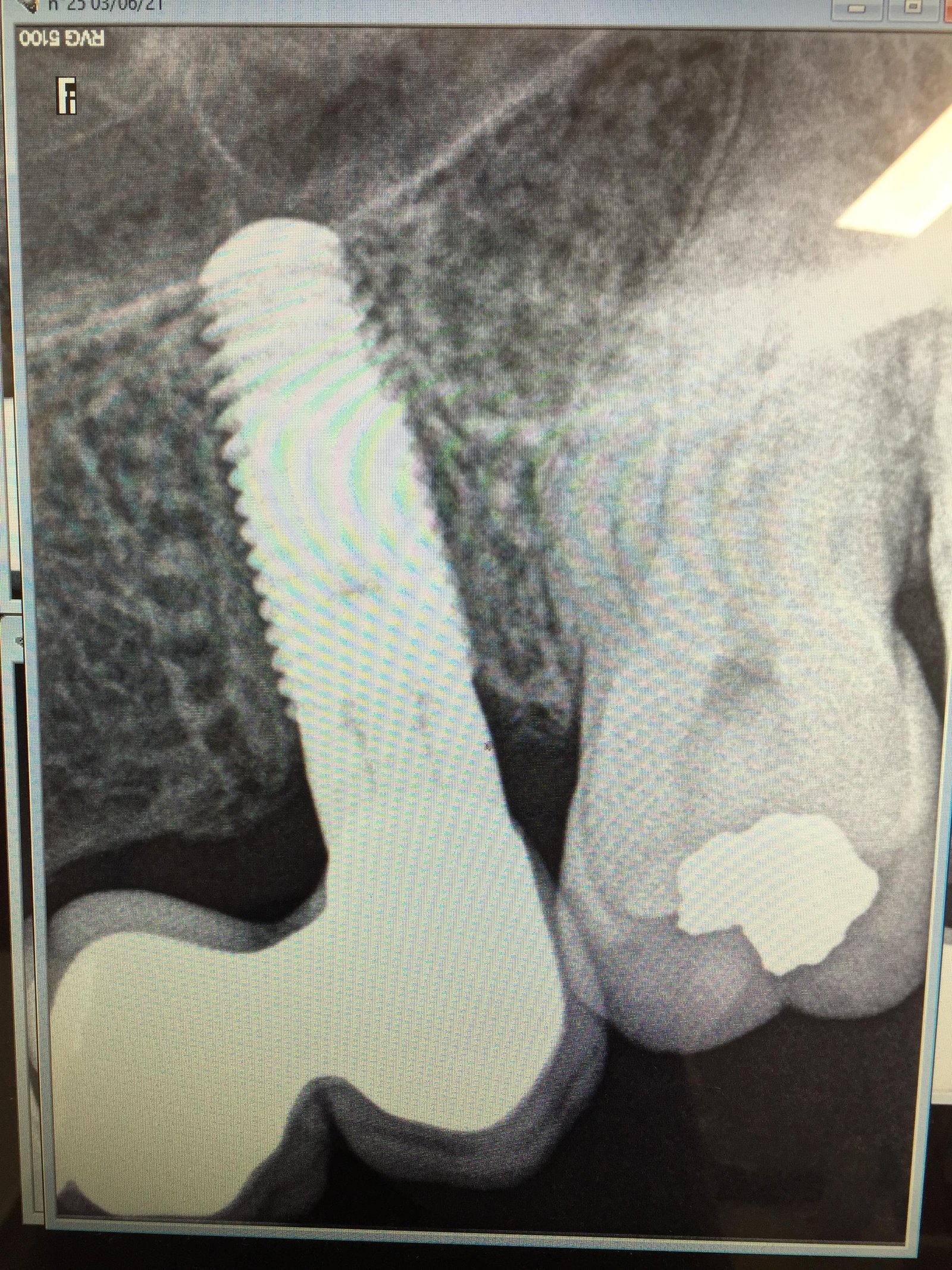 Implante con corona cementada
