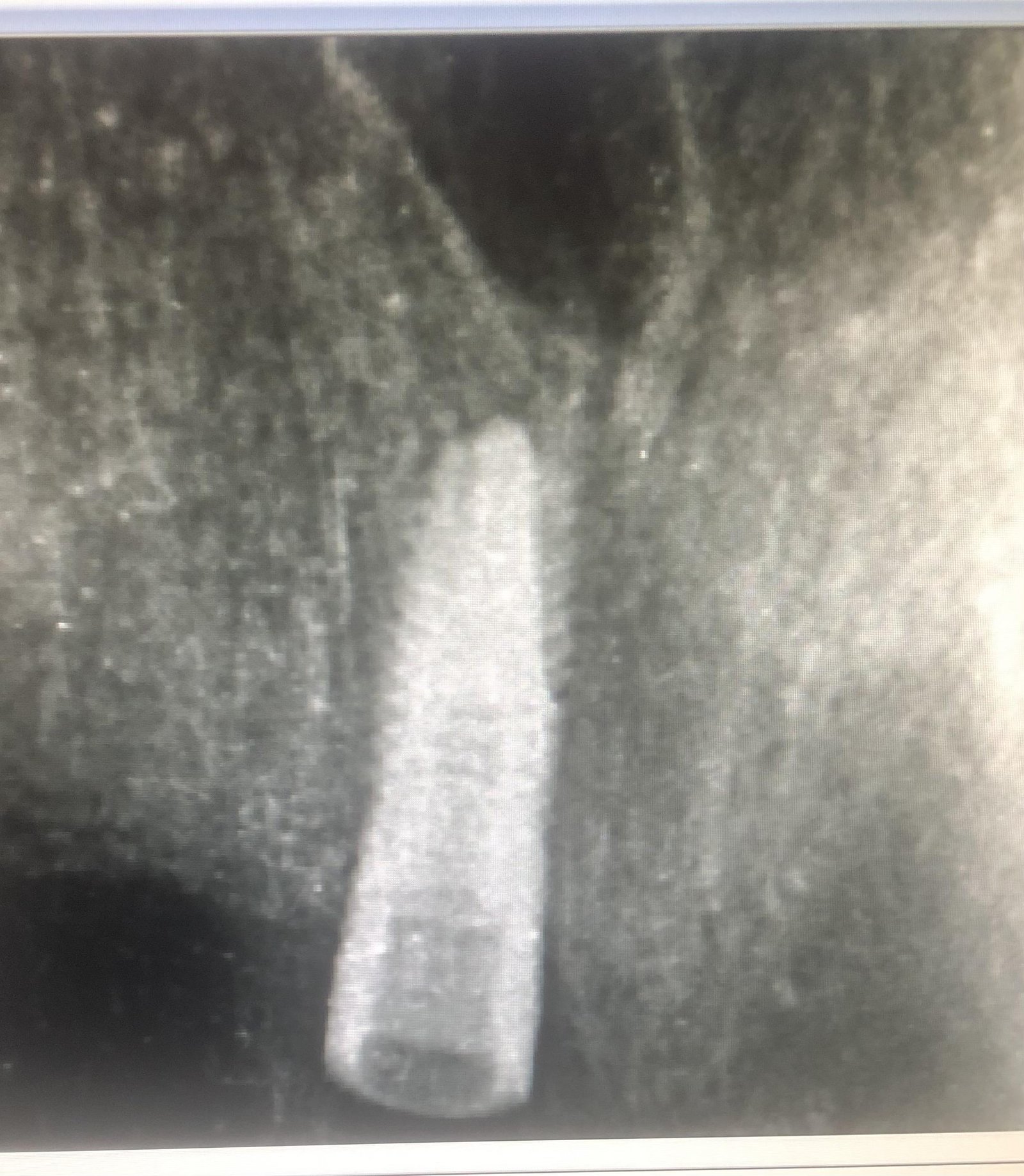 RX PERIAPICAL IMPLANTE POSICIÓN 11 