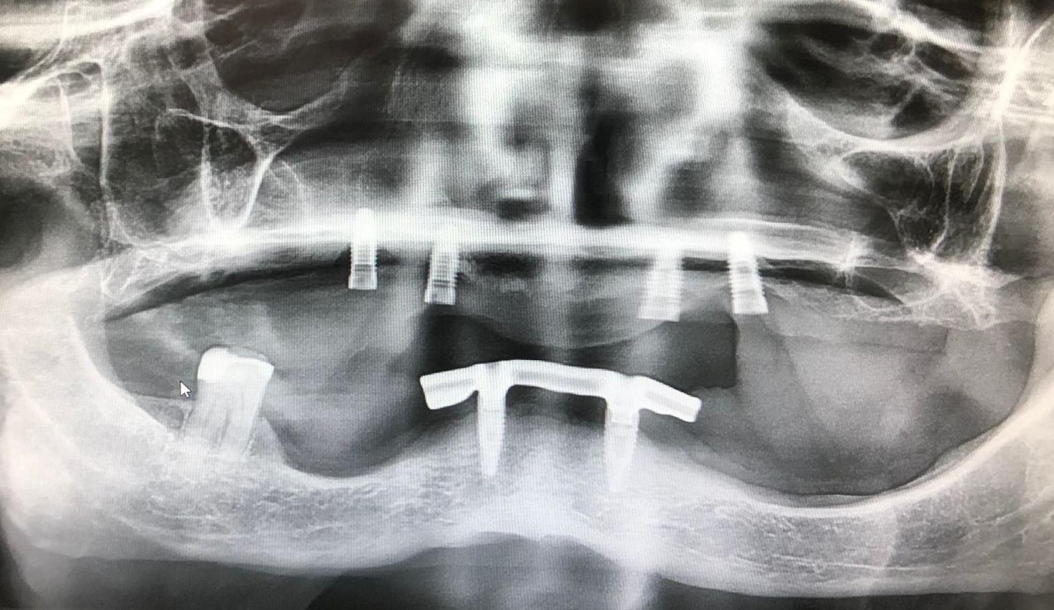 IMPLANTES SUPERIORES