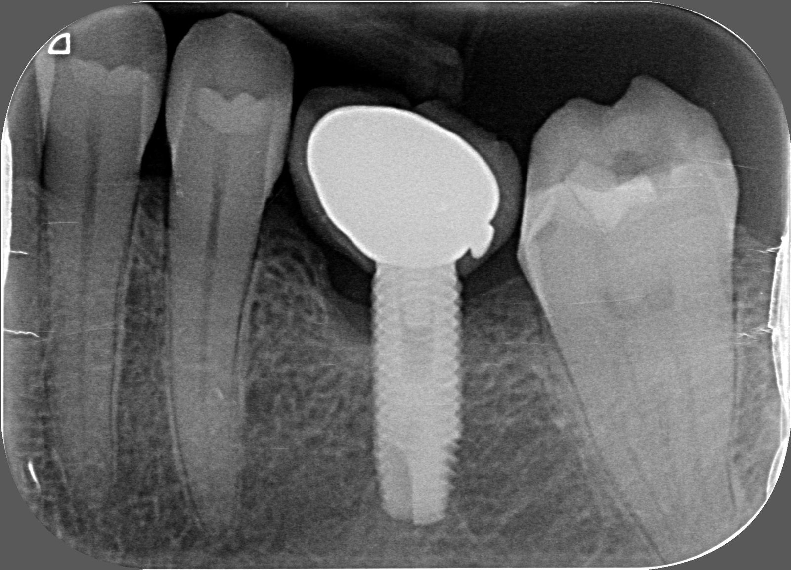 Radiografia Periapical