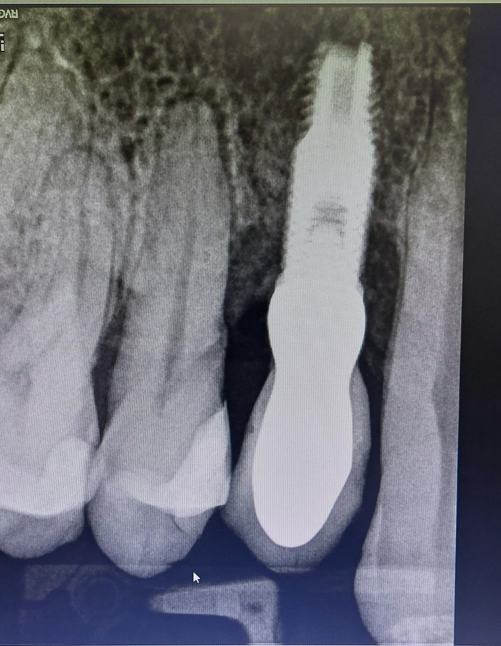 Periapical