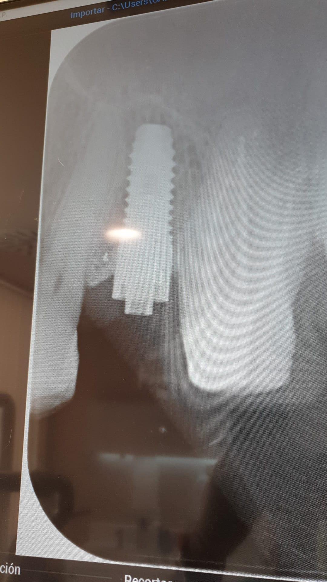 periapical ioi 25