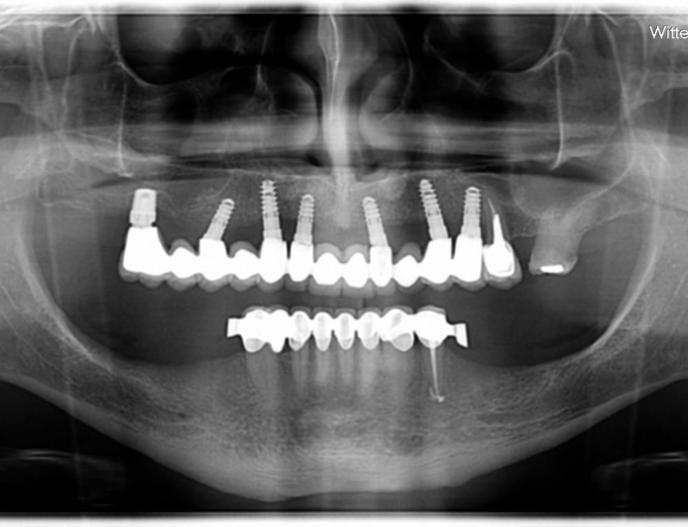 Bone Level Tapered 4.8 - Straumann - Implant Detective