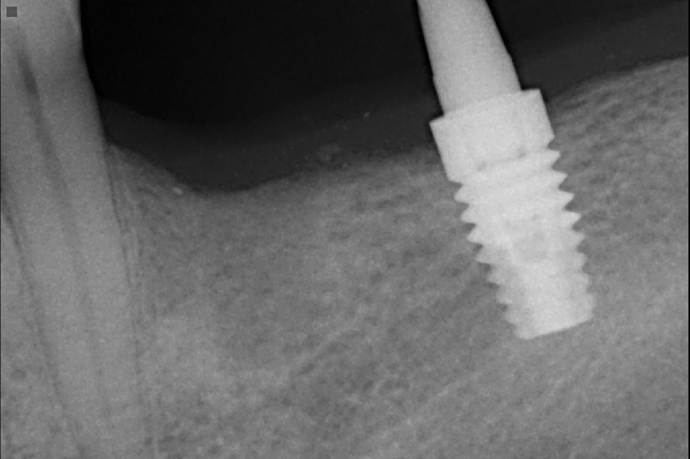 periapical implante